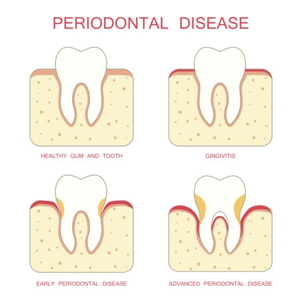 Bleeding Gums Annapolis MD | Gum Disease | Gingivitis